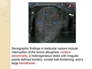 Sonographic findings in testicular rupture include
interruption of the tunica albuginea, contour
abnormality, a heterogeneous testis with irregular,
poorly defined borders, scrotal wall thickening, and a
large hematocele
 