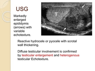 USG
Markedly
enlarged
epididymis
(arrows) with
variable
echotexture.
Reactive hydrocele or pyocele with scrotal
wall thickening.
Diffuse testicular involvement is confirmed
by testicular enlargement and heterogenous
testicular Echotexture.
 