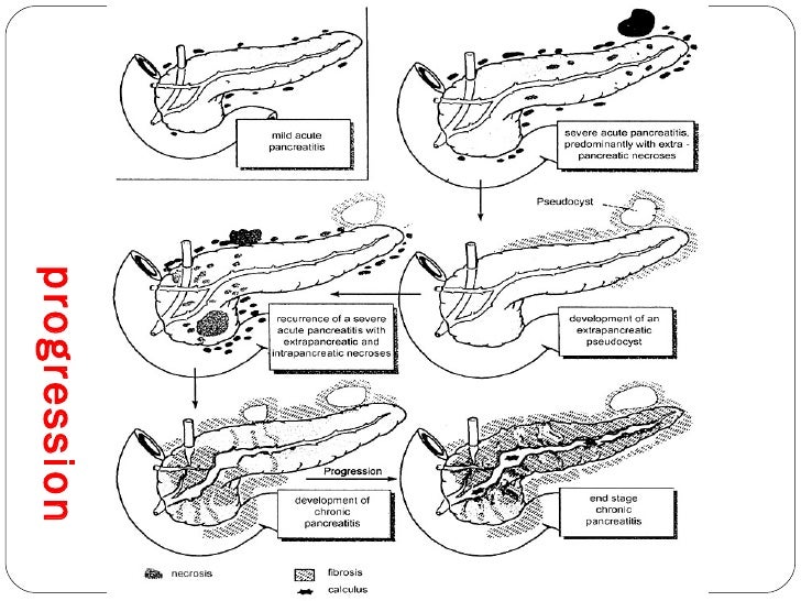 Acute Pancreatitis
