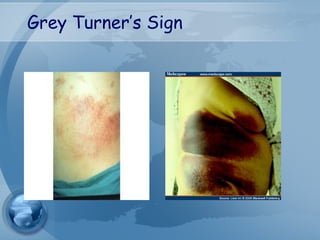 Grey Turner’s Sign
 