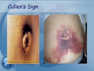 Cullen’s Sign
 