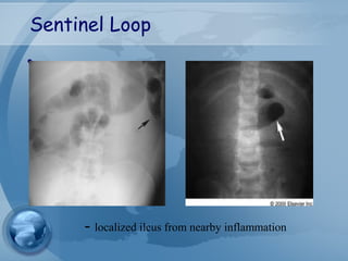 Sentinel Loop
•
- localized ileus from nearby inflammation
 