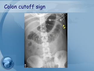 Colon cutoff sign
 