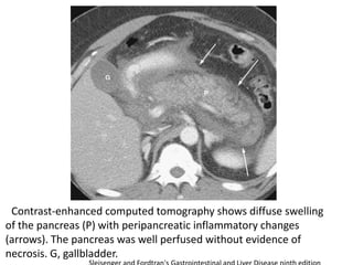 Contrast-enhanced computed tomography shows diffuse swelling
of the pancreas (P) with peripancreatic inflammatory changes
(arrows). The pancreas was well perfused without evidence of
necrosis. G, gallbladder.

 