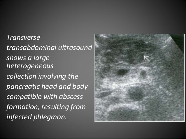 Acute pancreatitis