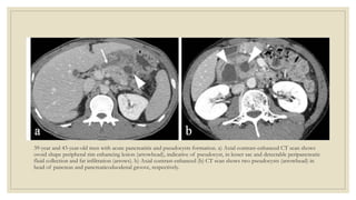39-year and 43-year-old men with acute pancreatitis and pseudocysts formation. a) Axial contrast-enhanced CT scan shows
ovoid shape peripheral rim enhancing lesion (arrowhead), indicative of pseudocyst, in lesser sac and detectable peripancreatic
fluid collection and fat infiltration (arrows). b) Axial contrast-enhanced (b) CT scan shows two pseudocysts (arrowhead) in
head of pancreas and pancreaticoduodenal groove, respectively.
 