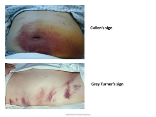 Cullen’s sign
Grey Turner’s sign
abdominal examination
 