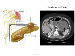complications
Pseudocyst on CT scan
 