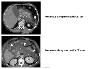 Acute exudative pancreatitis CT scan
Acute necrotizing pancreatitis CT scan
investigations
 