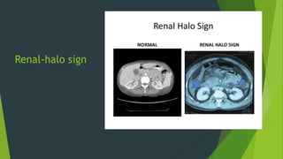 Renal-halo sign
 