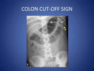 COLON CUT-OFF SIGN
 