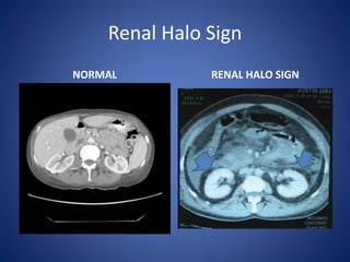 Renal Halo Sign
NORMAL RENAL HALO SIGN
 