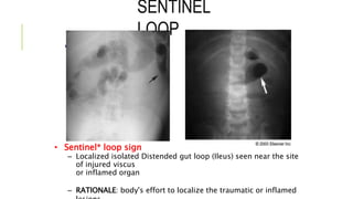 SENTINEL
LOOP
•
• Sentinel* loop sign
– Localized isolated Distended gut loop (Ileus) seen near the site
of injured viscus
or inflamed organ
– RATIONALE: body's effort to localize the traumatic or inflamed
 