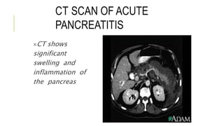CT SCAN OF ACUTE
PANCREATITIS
CT shows
significant
swelling and
inflammation of
the pancreas
 