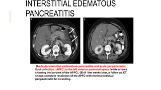 INTERSTITIAL EDEMATOUS
PANCREATITIS
(A) Acute interstitial oedematous pancreatitis and acute peripancreatic
fluid collection (APFC) in the left anterior pararenal space (white arrows
showing the borders of the APFC). (B) A few weeks later, a follow up CT
shows complete resolution of the APFC with minimal residual
peripancreatic fat stranding.
 