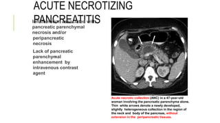 ACUTE NECROTIZING
PANCREATITIS

Inflammation associated with
pancreatic parenchymal
necrosis and/or

peripancreatic
necrosis
Lack of pancreatic
parenchymal
enhancement by
intravenous contrast
agent
Acute necrotic collection (ANC) in a 47-year-old
woman involving the pancreatic parenchyma alone.
Thin white arrows denote a newly developed,
slightly heterogeneous collection in the region of
the neck and body of the pancreas, without
extension in the peripancreatic tissues.
 