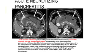 ACUTE NECROTIZING
PANCREATITIS
Acute necrotic collections (ANC) in a 44-year-old man with acute necrotising pancreatitis
involving only the peripancreatic tissues. Enhancement of the entire pancreatic
parenchyma (white stars) and the heterogeneous, non-liquid peripancreatic components in
the retroperitoneum (white arrows pointing at the borders of the ANC). (B) The ANC in the
same patient but imaged a few weeks later demonstrate a heterogeneous collection with
areas of fat (black arrowheads) surrounded by fluid density. This finding is typical for
peripancreatic necrosis. White arrows denote border of ANC; white stars denote
enhancement
 