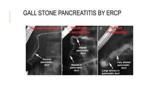 GALL STONE PANCREATITIS BY ERCP
 