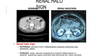 RENAL HALO
SIGNNORMAL RENAL HALO SIGN
• Renal halo sign
– RATIONALE: peripancreatic inflammatory reaction extension into
pararenal space
– ETIOLOGY: water-density (radiolucent-halo)of inflammation in
anterior pararenal space contrasts with perirenal fat; more common
 