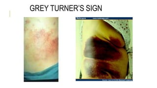 GREY TURNER’S SIGN
 