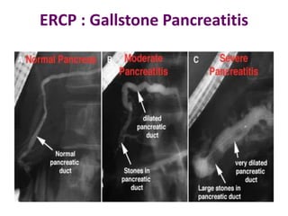 ERCP : Gallstone Pancreatitis
 