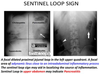 A focal dilated proximal jejunal loop in the left upper quadrant. A focal
area of adynamic ileus close to an intraabdominal inflammatory process
The sentinel loop sign may aid in localizing the source of inflammation.
Sentinel Loop in upper abdomen may indicate Pancreatitis
 