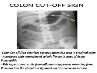 -Colon Cut-off Sign describes gaseous distension seen in proximal colon
- Associated with narrowing of splenic flexure in cases of Acute
Pancreatitis
- This Appearance results from inflammatory process extending from
Pancreas into the phrenicolic ligament via transverse mesocolon
 