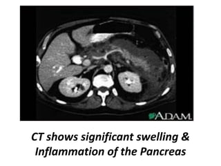CT shows significant swelling &
Inflammation of the Pancreas
 