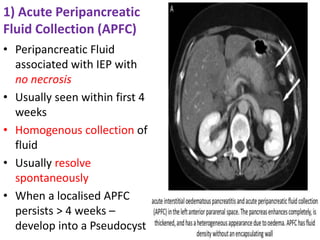 1) Acute Peripancreatic
Fluid Collection (APFC)
• Peripancreatic Fluid
associated with IEP with
no necrosis
• Usually seen within first 4
weeks
• Homogenous collection of
fluid
• Usually resolve
spontaneously
• When a localised APFC
persists > 4 weeks –
develop into a Pseudocyst
 