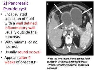 2) Pancreatic
Pseudo cyst
• Encapsulated
collection of fluid
with a well defined
inflammatory wall
usually outside the
pancreas
• With minimal or no
necrosis
• Usually round or oval
• Appears after 4
weeks of onset IEP
-Note the two round, homogenous fluid
collection with a well defined borders
- White stars denote normal enhancing
pancreas
 