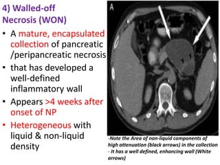 4) Walled-off
Necrosis (WON)
• A mature, encapsulated
collection of pancreatic
/peripancreatic necrosis
• that has developed a
well-defined
inflammatory wall
• Appears >4 weeks after
onset of NP
• Heterogeneous with
liquid & non-liquid
density
-Note the Area of non-liquid components of
high attenuation (black arrows) in the collection
- It has a well defined, enhancing wall (White
arrows)
 