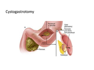 Cystogastrotomy
 