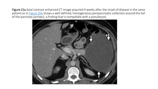Figure 21a Axial contrast-enhanced CT image acquired 4 weeks after the onset of disease in the same
patient as in Figure 20a shows a well-defined, homogeneous peripancreatic collection around the tail
of the pancreas (arrows), a finding that is compatible with a pseudocyst.
 