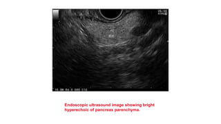 Endoscopic ultrasound image showing bright
hyperechoic of pancreas parenchyma.
 