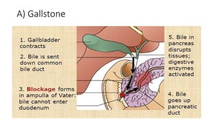 A) Gallstone
 