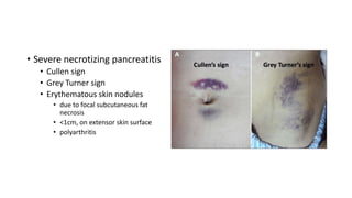• Severe necrotizing pancreatitis
• Cullen sign
• Grey Turner sign
• Erythematous skin nodules
• due to focal subcutaneous fat
necrosis
• <1cm, on extensor skin surface
• polyarthritis
 