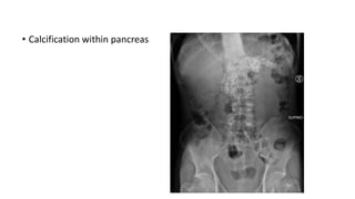 • Calcification within pancreas
 
