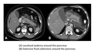 (A) Localised oedema around the pancreas
(B) Extensive fluid collections around the pancreas
 