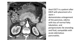 Axial CECT in a patient after
ERCP with placement of a
stent >
demonstrates enlargement
of the pancreas, edema
with loss of normal fatty
lobulation, and
peripancreatic fat stranding
and fluid, compatible with
acute edematous
pancreatitis.
 
