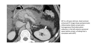 IEP in a 43-year-old man. Axial contrast-
enhanced CT image shows peripancreatic
inflammation (black arrow) and a
homogeneous fluid-attenuation
collection in the left anterior pararenal
space (white arrow), a finding that is
consistent with APFC.
 