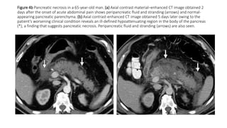 Figure 4b Pancreatic necrosis in a 65-year-old man. (a) Axial contrast material–enhanced CT image obtained 2
days after the onset of acute abdominal pain shows peripancreatic fluid and stranding (arrows) and normal-
appearing pancreatic parenchyma. (b) Axial contrast-enhanced CT image obtained 5 days later owing to the
patient’s worsening clinical condition reveals an ill-defined hypoattenuating region in the body of the pancreas
(*), a finding that suggests pancreatic necrosis. Peripancreatic fluid and stranding (arrows) are also seen.
 