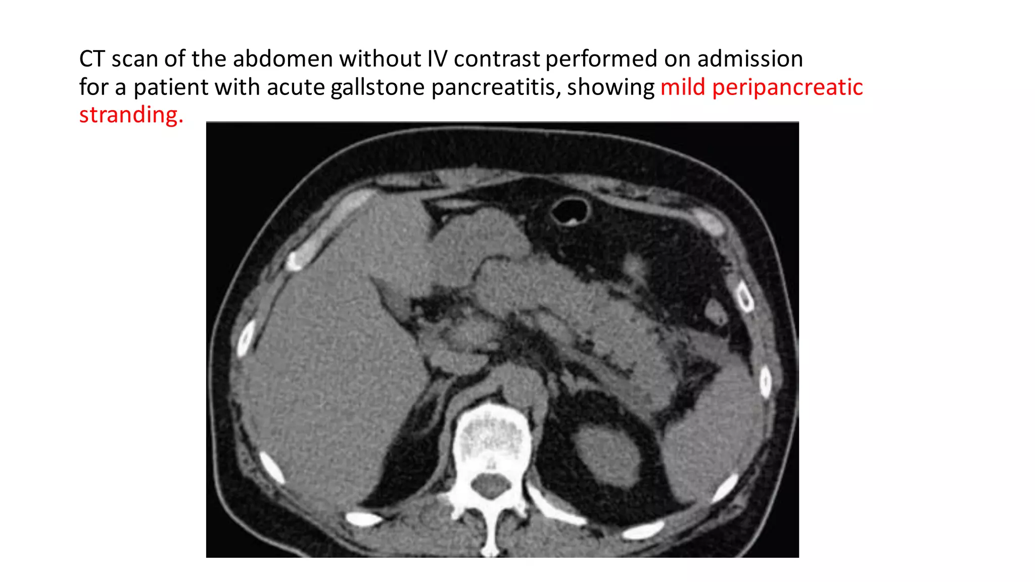 CT scan of the abdomen without IV contrast performed on admission
for a patient with acute gallstone pancreatitis, showing mild peripancreatic
stranding.
 