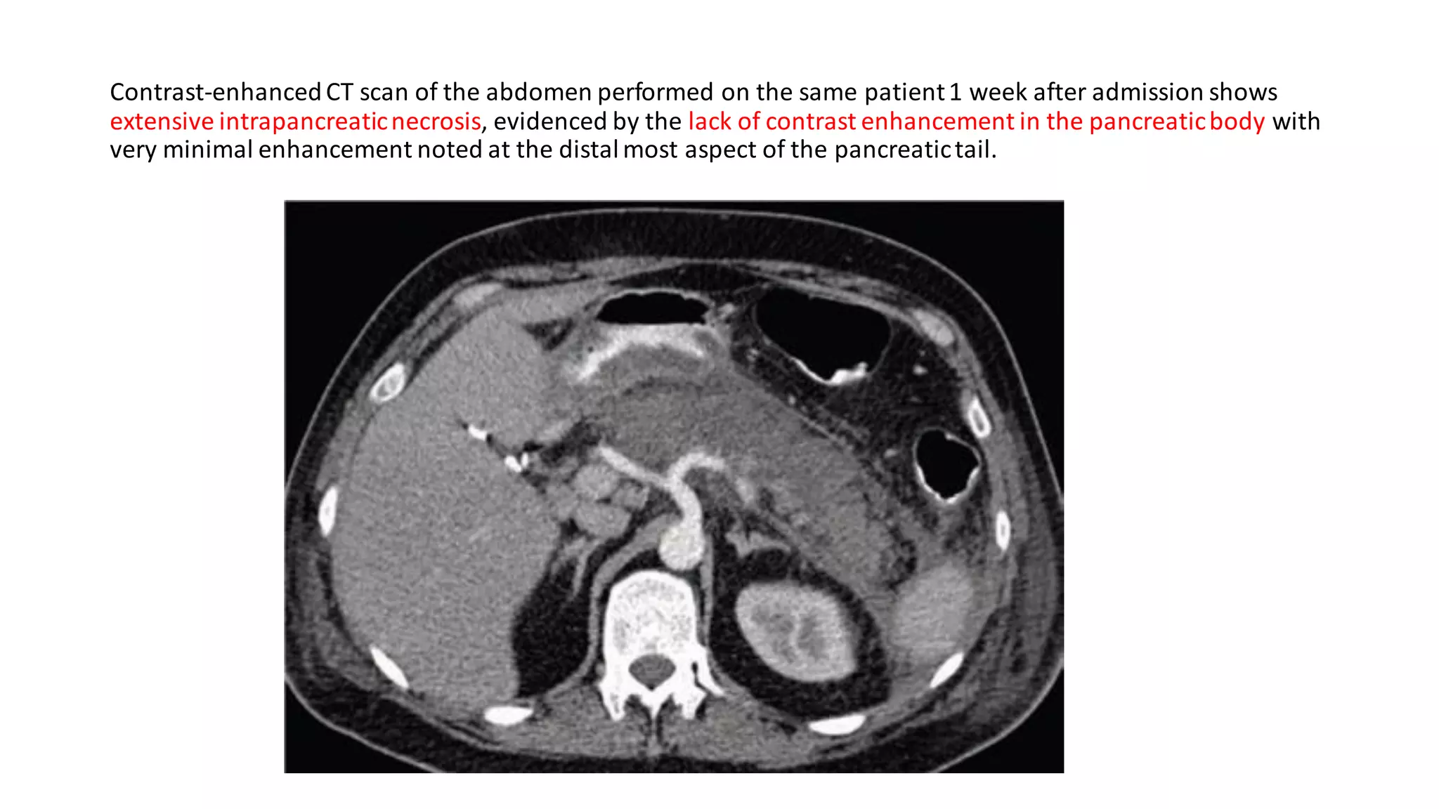 Contrast-enhancedCT scan of the abdomen performed on the same patient1 week after admission shows
extensive intrapancreaticnecrosis, evidenced by the lack of contrast enhancement in the pancreaticbody with
very minimal enhancement noted at the distalmost aspect of the pancreatictail.
 