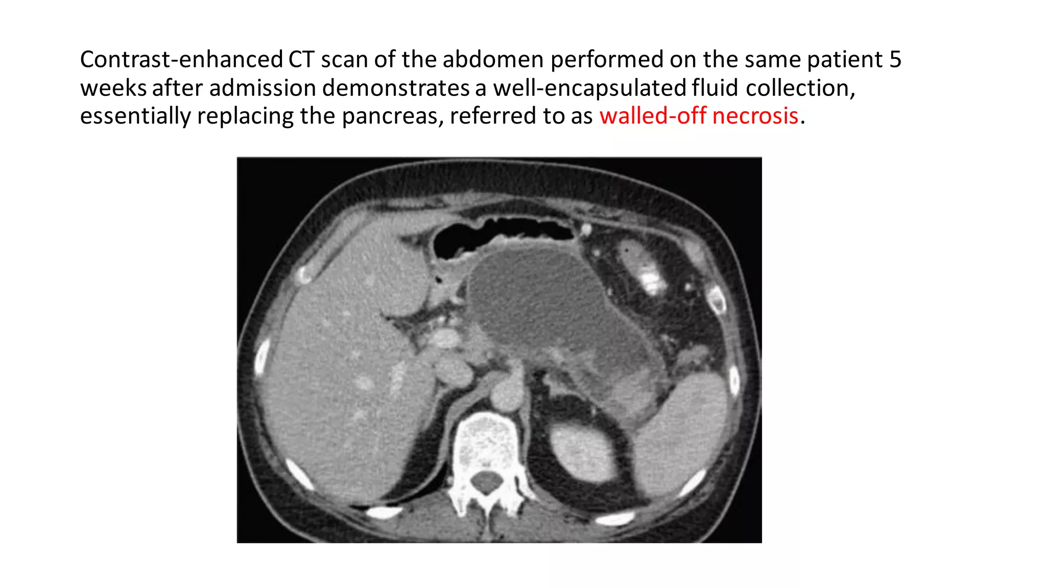 Contrast-enhanced CT scan of the abdomen performed on the same patient 5
weeks after admission demonstrates a well-encapsulated fluid collection,
essentially replacing the pancreas, referred to as walled-off necrosis.
 