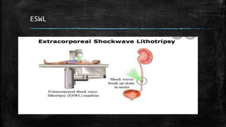 ESWL
 