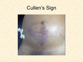 Cullen’s Sign
 