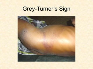 Grey-Turner’s Sign
 