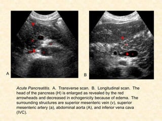 A
Acute Pancreatitis. A. Transverse scan. B. Longitudinal scan. The
head of the pancreas (H) is enlarged as revealed by the red
arrowheads and decreased in echogenicity because of edema. The
surrounding structures are superior mesenteric vein (v), superior
mesenteric artery (a), abdominal aorta (A), and inferior vena cava
(IVC).
B
 