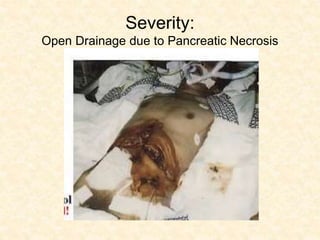Severity:
Open Drainage due to Pancreatic Necrosis
 