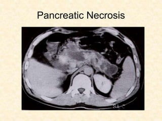 Pancreatic Necrosis
 